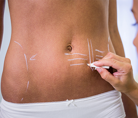 Vibrolipoaspiração