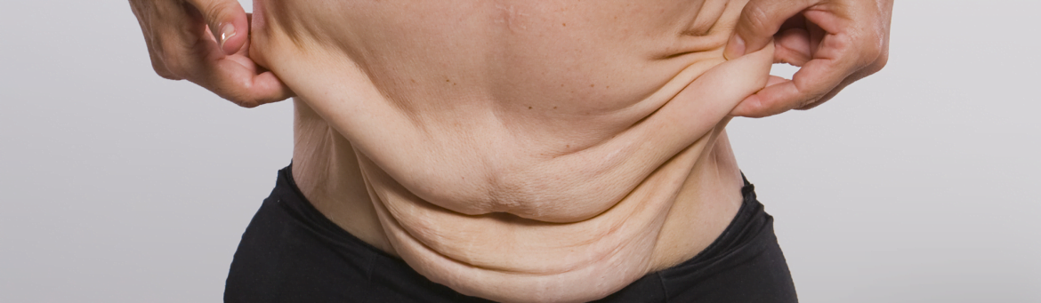 Conheça o procedimento pós-cirurgia bariátrica