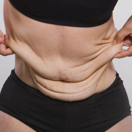 Conheça o procedimento pós-cirurgia bariátrica